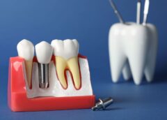 Implant Dentar Bredent: De Ce Este Ales Pentru Reabilitări Rapide